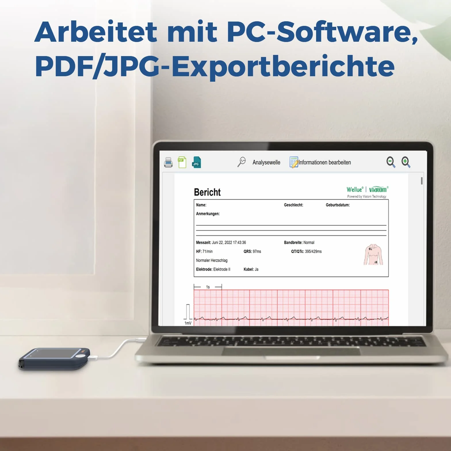 ViATOM Appareil ECG Portable – Moniteur ECG Bluetooth avec Affichage en Temps Réel et Mémoire Illimitée